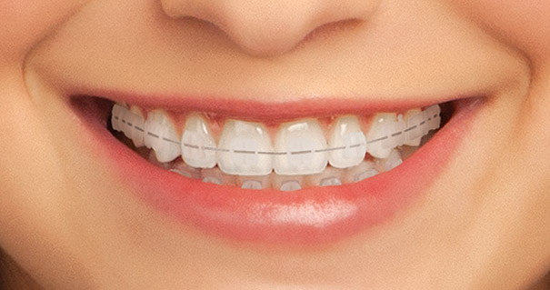Clear Braces Tonowanda Clarence NY